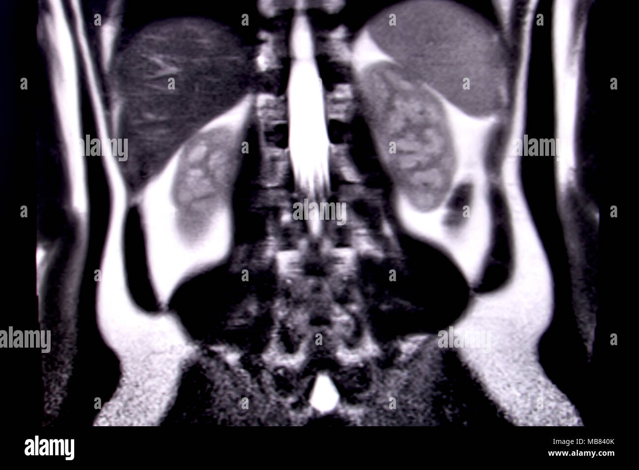 Fahrt durch die menschlichen Bauch und Brust durch 18 MRT-Schnitte (koronale Ansicht). Bild 13/18 Stockfoto