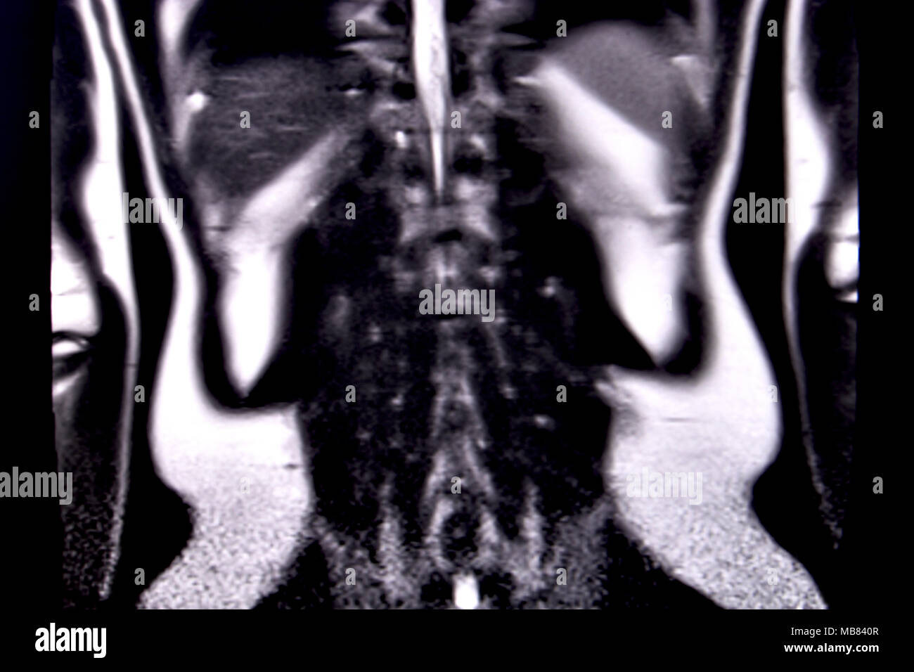 Fahrt durch die menschlichen Bauch und Brust durch 18 MRT-Schnitte (koronale Ansicht). Bild 15/18 Stockfoto