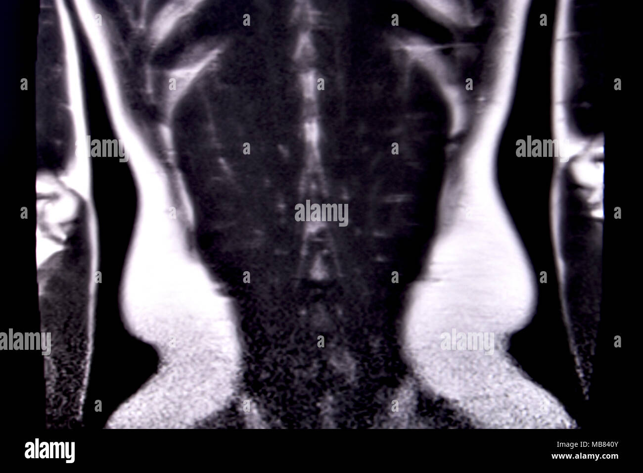 Fahrt durch die menschlichen Bauch und Brust durch 18 MRT-Schnitte (koronale Ansicht). Bild 17/18 Stockfoto