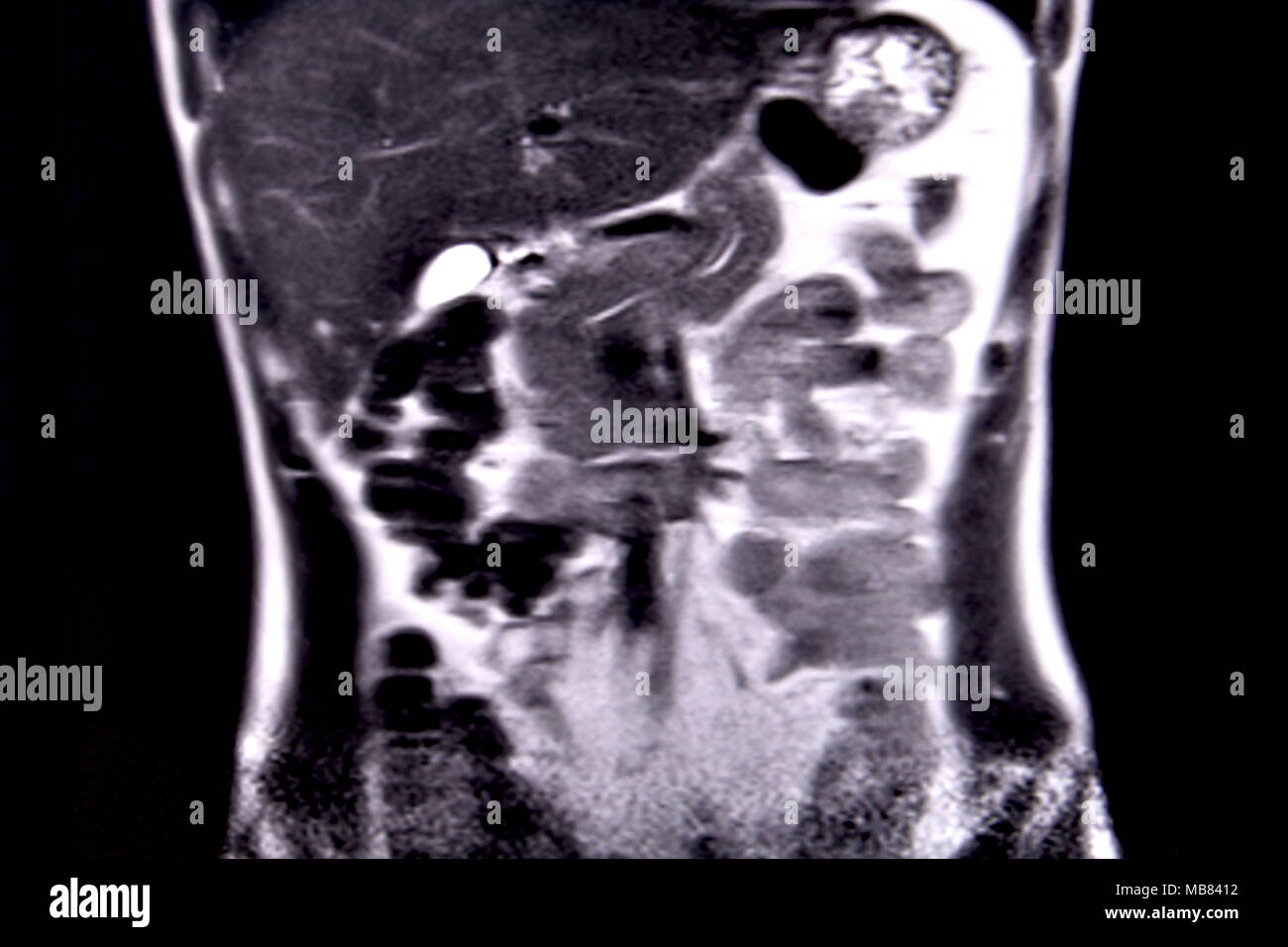 Fahrt durch die menschlichen Bauch und Brust durch 18 MRT-Schnitte (koronale Ansicht). Bild 1/18 Stockfoto