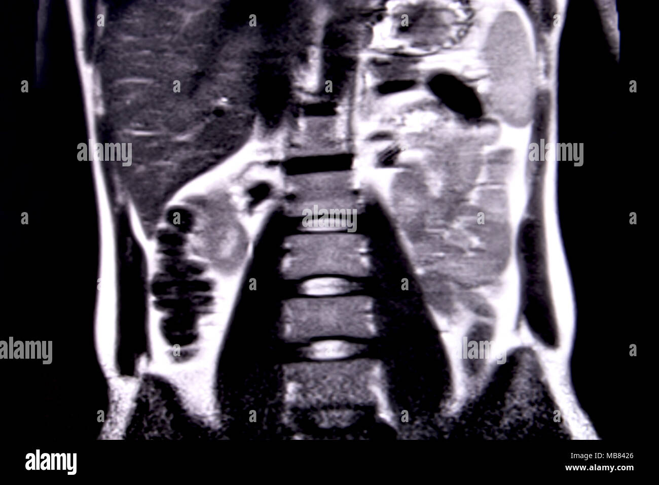 Fahrt durch die menschlichen Bauch und Brust durch 18 MRT-Schnitte (koronale Ansicht). Bild 7/18 Stockfoto