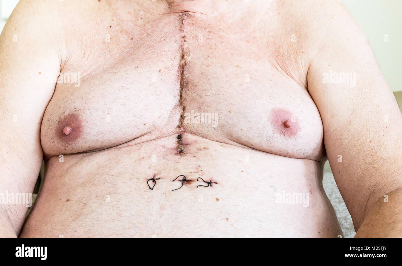 Narbe Patient Brust Wunde Operation Stockfotos Und Bilder Kaufen Alamy