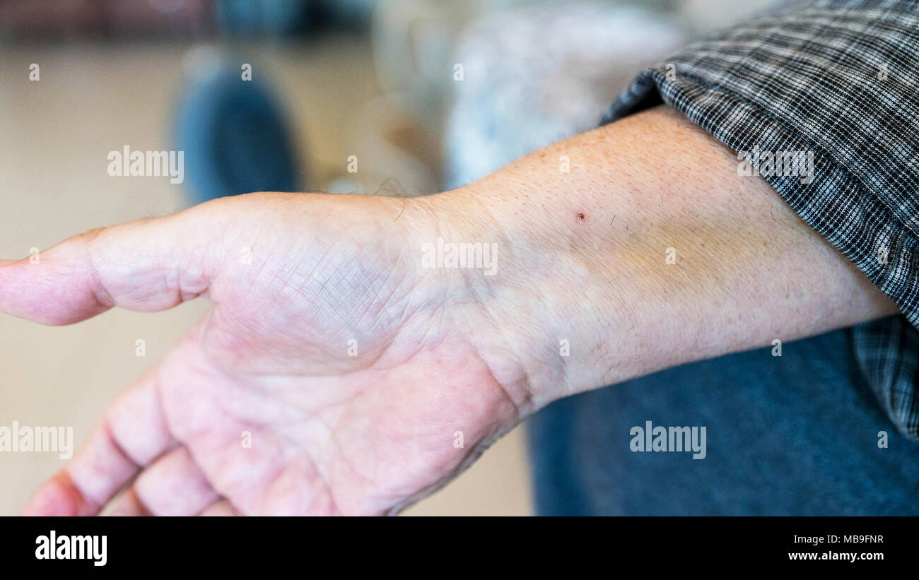 Ein alter Mann die Hand mit der Punkt nach Durchlaufen einer stent Installation im Herzen nach einem Herzinfarkt. Stockfoto