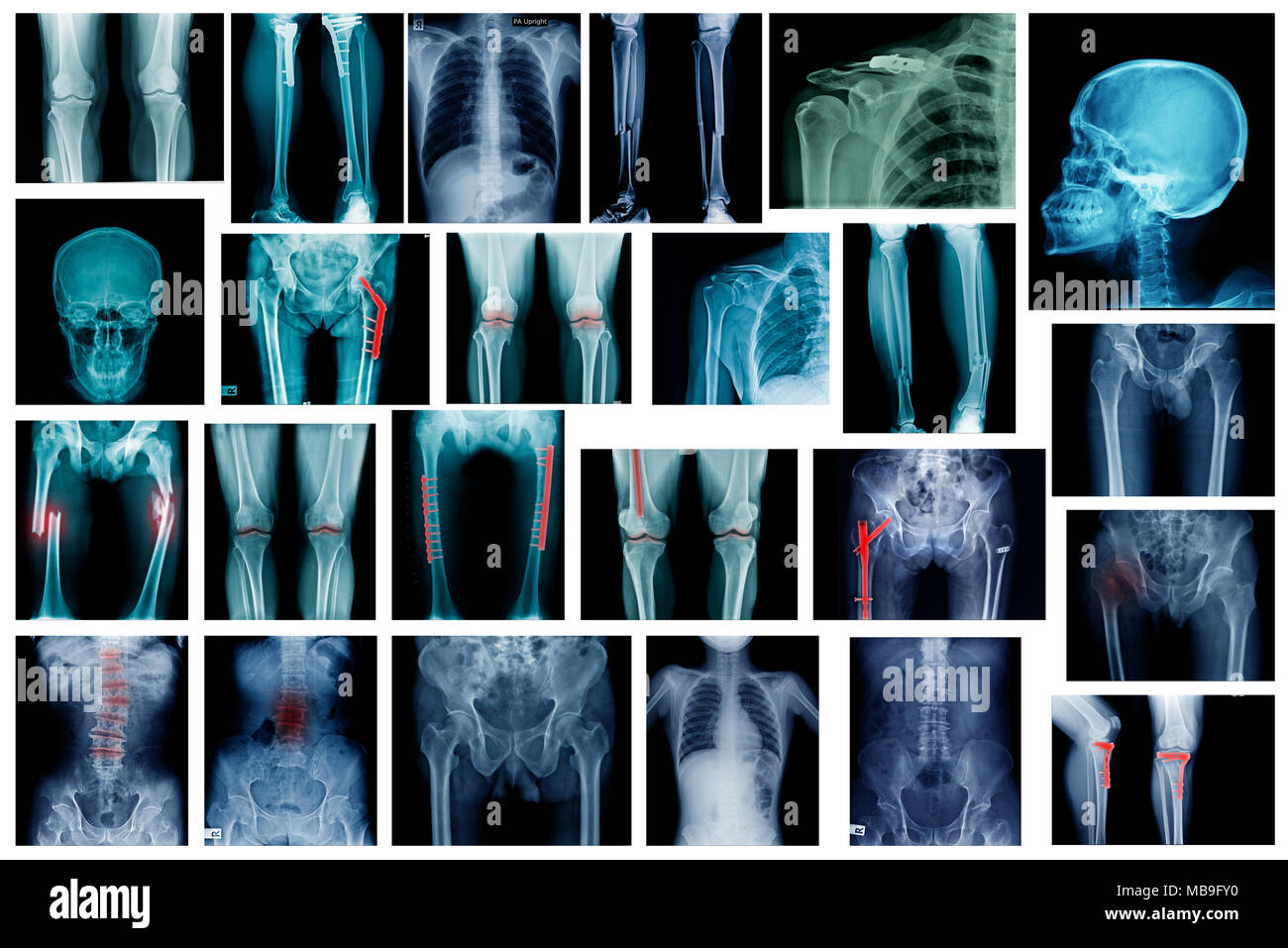 Hochwertige Sammlung x-ray Bild zeigen viele Körper Teil der menschlichen Stockfoto