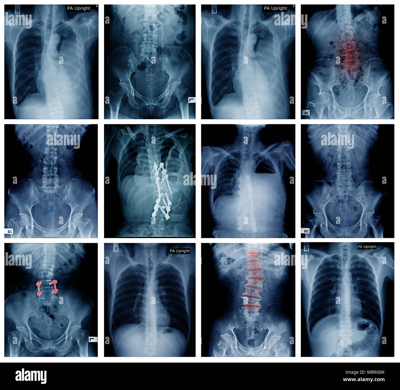 Große Sammlung zurück und Becken- x-ray, hohe Qualität setof x-ray Stockfoto