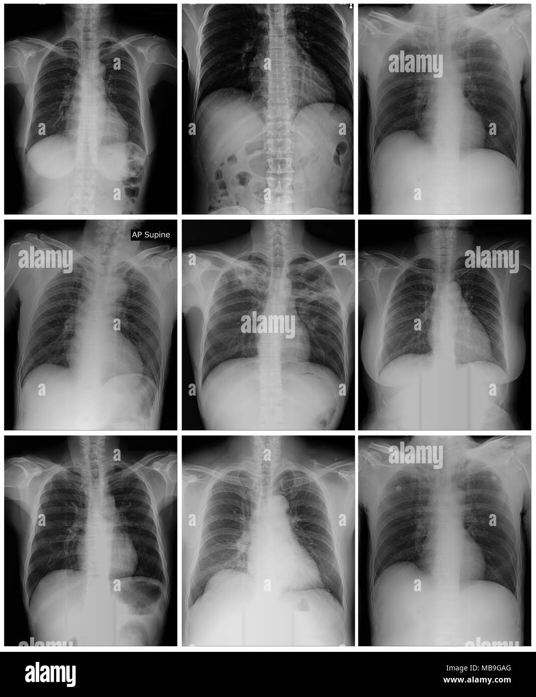 Sammlung Chest X-Ray, hochwertige film Brust einfache Auswahl Stockfoto