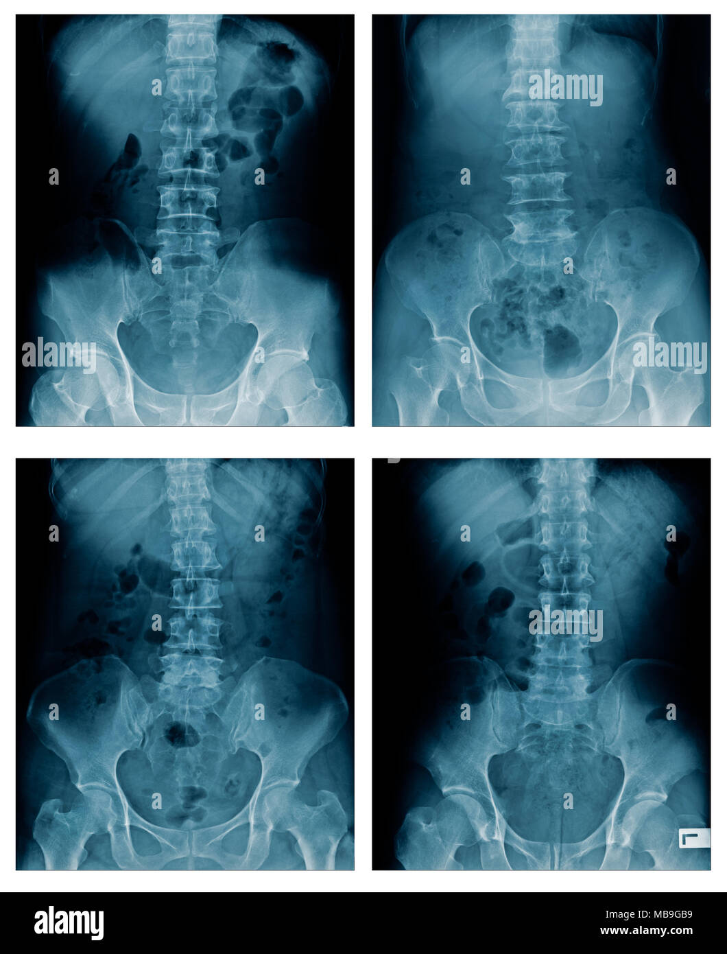 Sammlung der Wirbelsäule x-ray Image Stockfoto