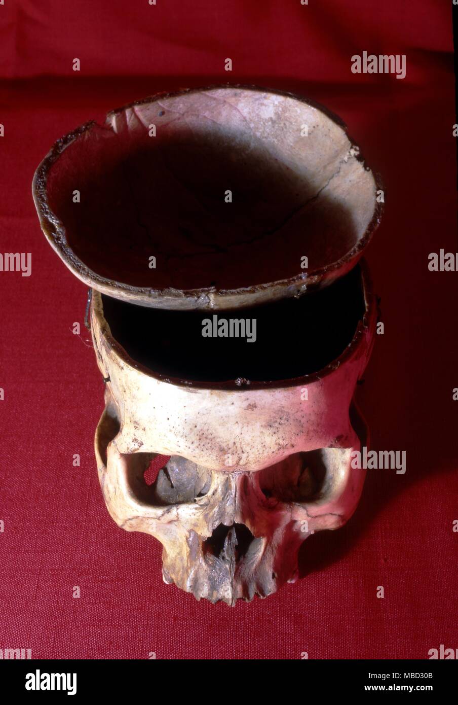 Trepanned menschlicher Schädel mit der Oberseite entfernt. Stockfoto