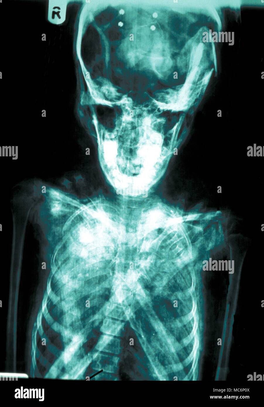 Ägyptische MUMIE X-ray der Schädel eines Mumie der Ptolemäerzeit. Die Mumie ist, dass von einem jungen Mädchen, das starb an einem Unfall mit ihrem Kopf zerquetscht wurde, und ihre Oberschenkel in Ihr Becken gedrängt wurden. Cliffe Castle Museum. Stockfoto