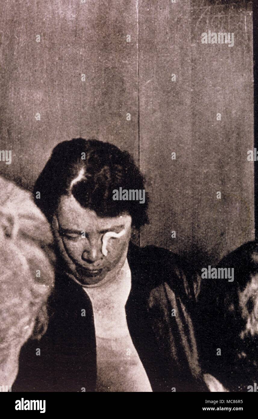 Psychische Phänomene Teleplasm - oder ektoplasma - seeminlgy aus dem Auge oder Nase des Mediums. Am 23. September 1928 in Winnipeg, Kanada fotografiert. Es gibt auch eine vertikale Schnur Projektion, die eine Glocke schellt bei der SEANCE Stockfoto