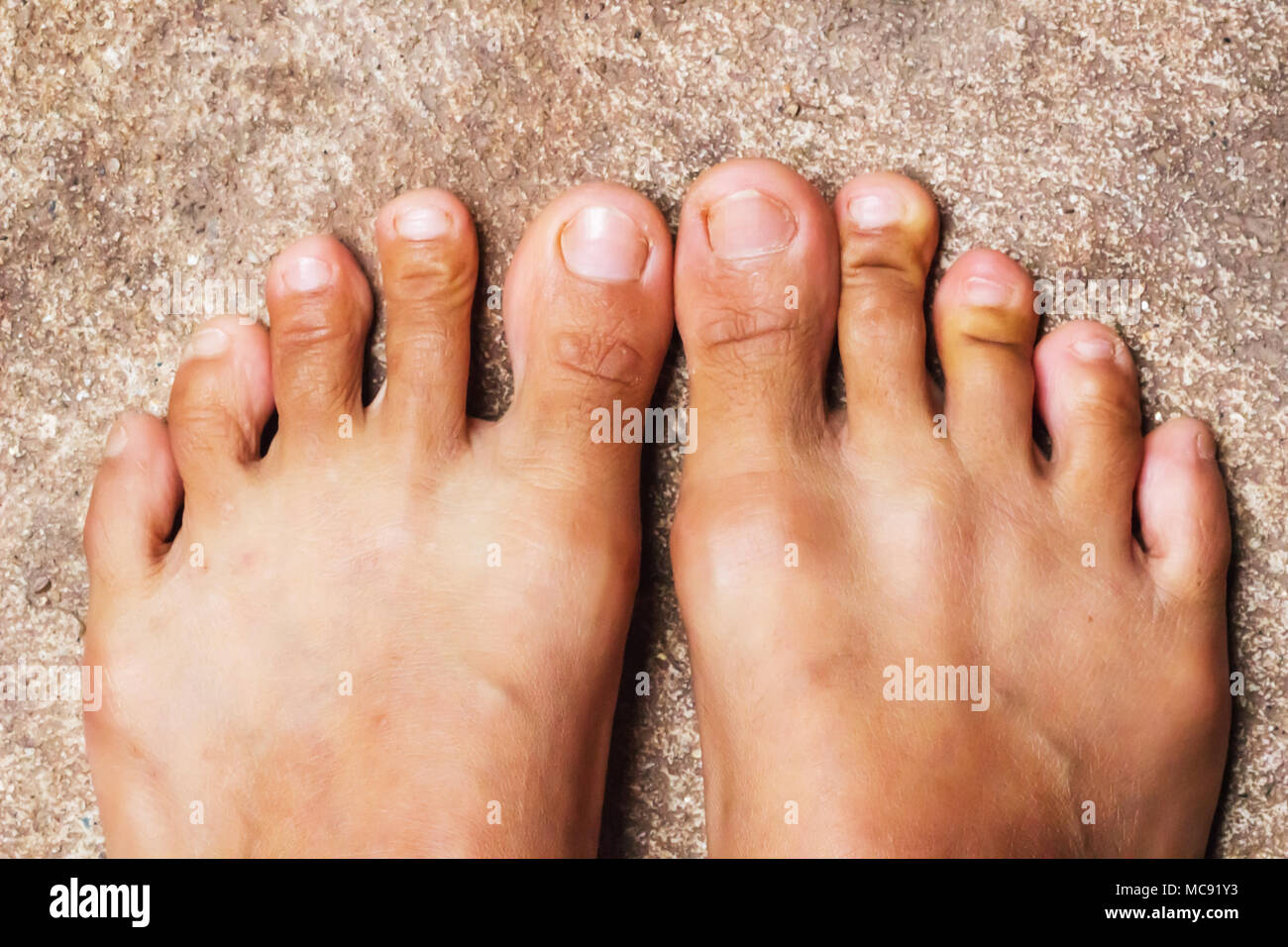 Fuß, Rheumatoid foot Krankheit Hintergrund. Stockfoto