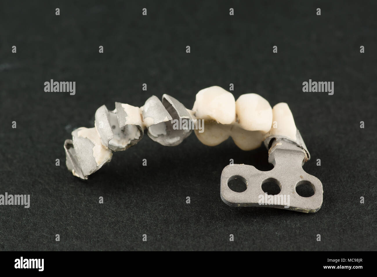 Beschädigte zahnmedizinische cermet Brücke Prothese auf eine lamellare Implantat Stockfoto