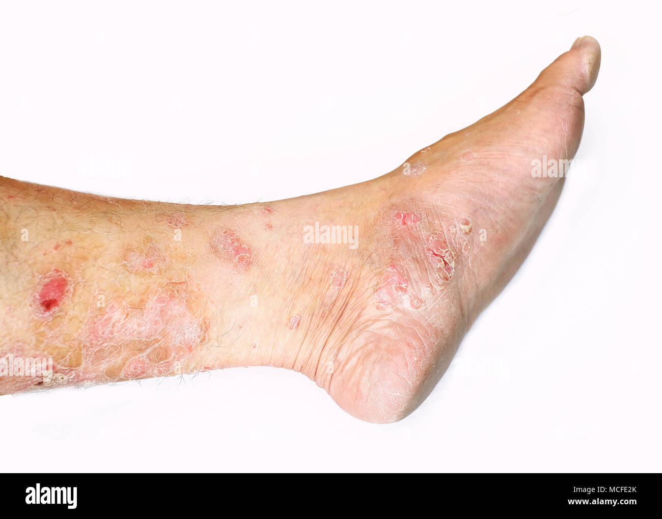 Psoriasis auf weißem Hintergrund Stockfoto