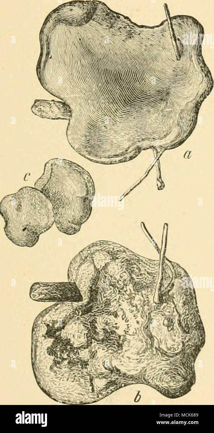 . Abb. H.-Spn, - der ophnrcs ndvAata Khizina v.v., Oberfläche; b, untere Fläche; c, kleine sporophores. (Nach Hartig.) Abb. 145.-Abschnitt der hymenium. a, Para-physes;?), Absondert - Röhren; c, Asci, mit je acht Sporen. (Nach Hartig.) Die Krankheit erstreckt sich von einem Zentrum und Angriffe eine Pflanze nach der anderen, wodurch sie ihre Nadeln und Sterben zu verlieren. Die sporophores sind groß (f bis 2 Zoll), Kastanien-braun, abgeflacht oder wellige Strukturen, die direkt auf das Myzel sitzen, ohne Stiel. Auf der oberen Fläche ist die ascogenous Schicht, die, wenn sie feucht, eigentümlich ist klebrig und "R. Hart Stockfoto