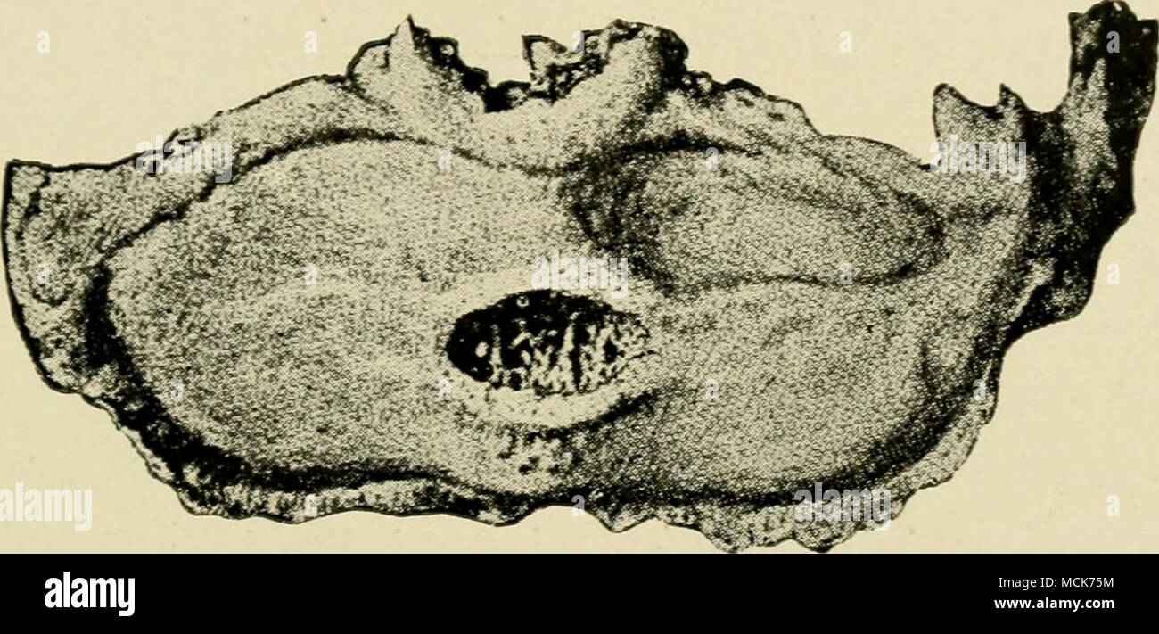 . Abb. 163, Das Strahlbein aus einem Fall von langjährigen