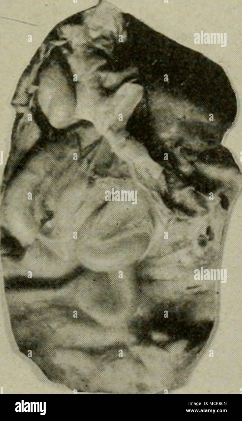 . 3 TB V CI Abb. loo - Tuberkulose der Eierstöcke und Eileiter. /, Abschnitt durch den Eileiter; 2, Eileiter zu Coils durch Dehnung geworfen; J, Ovar, die ein Corpus luteum, CI, und einer Tuberkulösen Masse, in Krater einer gebrochenen ovisac. ovarian als orchitic Tuberkulose erwartet werden. Es anscheinend das ist wahr. Dennoch ist der Fruchtknoten ist sehr re-Sistant auf die Infektion, im Vergleich mit anderen Teilen der weiblichen Genitalien. Häufig wird die Gebärmutter und oviducts sind hoch Tuberkuloseläsionen festgestellt, während die Eierstöcke normal bleibt. Im zweiten Beispiel der ovariellen Tuberkulose in meiner Sammlung, in der Abb. gezeigt. 101 Stockfoto