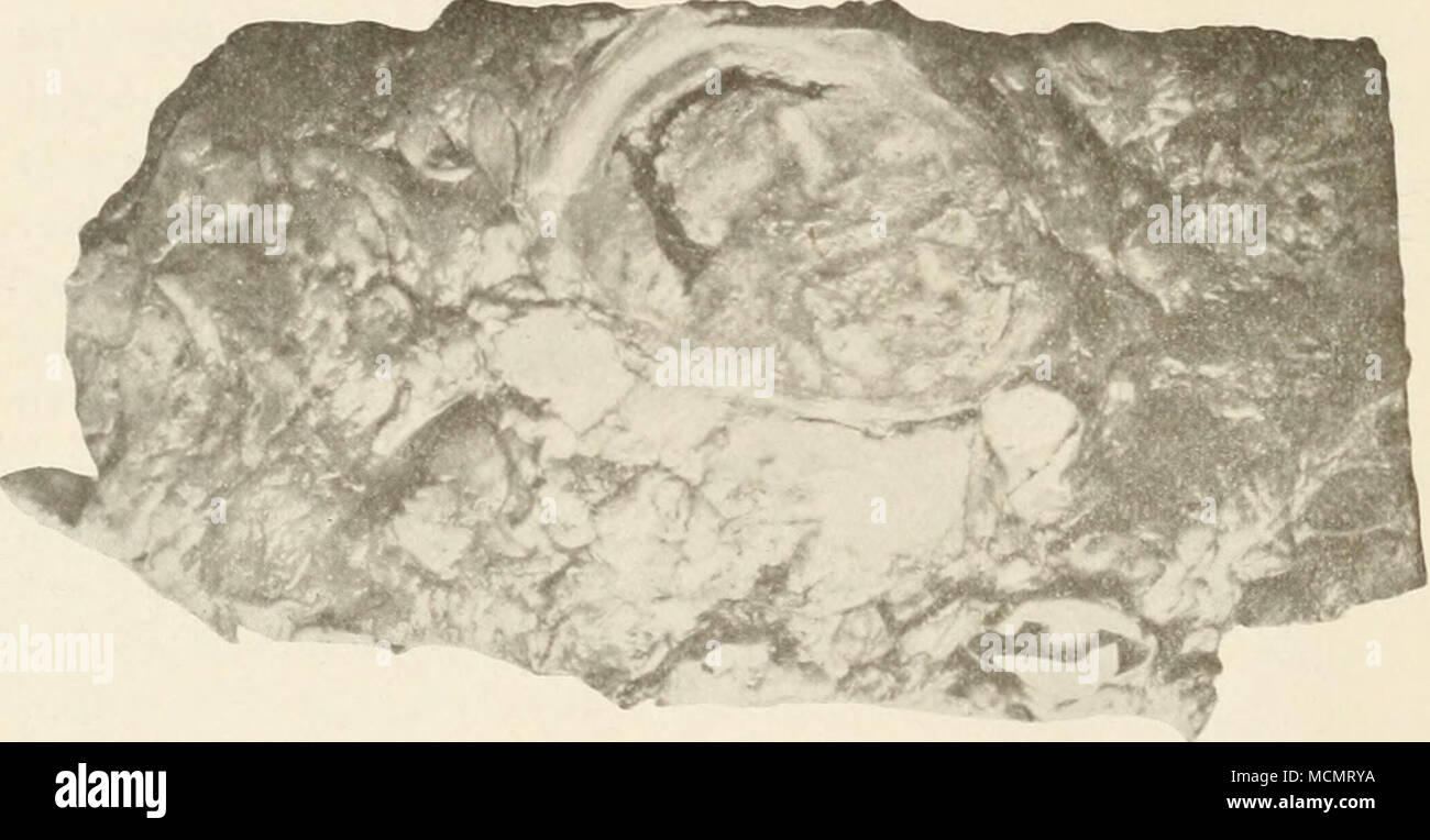 . Abb. 78. r/iotograph 0/ein Teil der Ein stellung eines coic, shoicing Bereich der Acti) wniycotic Gewebe durch eine Wand von Bindegewebe umgeben. Natürliche Größe. Organisierte aktinomykose nicht auftreten selten ist. Er gibt ein de-tailed Beschreibung von elf Fällen bei Rindern und Schweinen. Es ist von Lachs erklärte, dass in England die Krankheit ap-Birnen, die häufig in der Zunge, in Dänemark die weichen Teile des Kopfes am häufigsten betroffen sind, während es in einigen Teilen Deutschlands es am häufigsten in den Rachen gefunden wird. In den Vereinigten Staaten ist es in der Regel im Unterkiefer wird angezeigt. In den Menschen als an Vieh, das Erscheinungsbild der Les Stockfoto