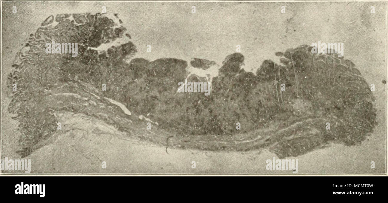 . Abb. 43. Eine photoi^ Raph einen Abschnitt einer Tuberkulösen Geschwür, von einem corv Darm, Sho 7c" in &Lt;tnaroinal rinfltration unter der Schleimhaut. Beitrag von Läsionen. Häufig Tiere getötet werden bald nach der Infektion stattgefunden hat, in diesem Fall die Läsionen sind begrenzte zu einem einzigen lymphatischen Drüsen und andere Organe. In anderen Fällen alte Verletzungen von erheblichen Anteil gefunden werden, wie in Abb. 1 gezeigt. 36, wo der Herzmuskel vollständig in einer dicken kalkigen tuberkulöse Kaution eingehüllt ist. In diesem Fall muss das Tier in gute fle wurde.sh und getötet für Rindfleisch ohne einen Verdacht, dass es in irgendeiner Weise dise Stockfoto