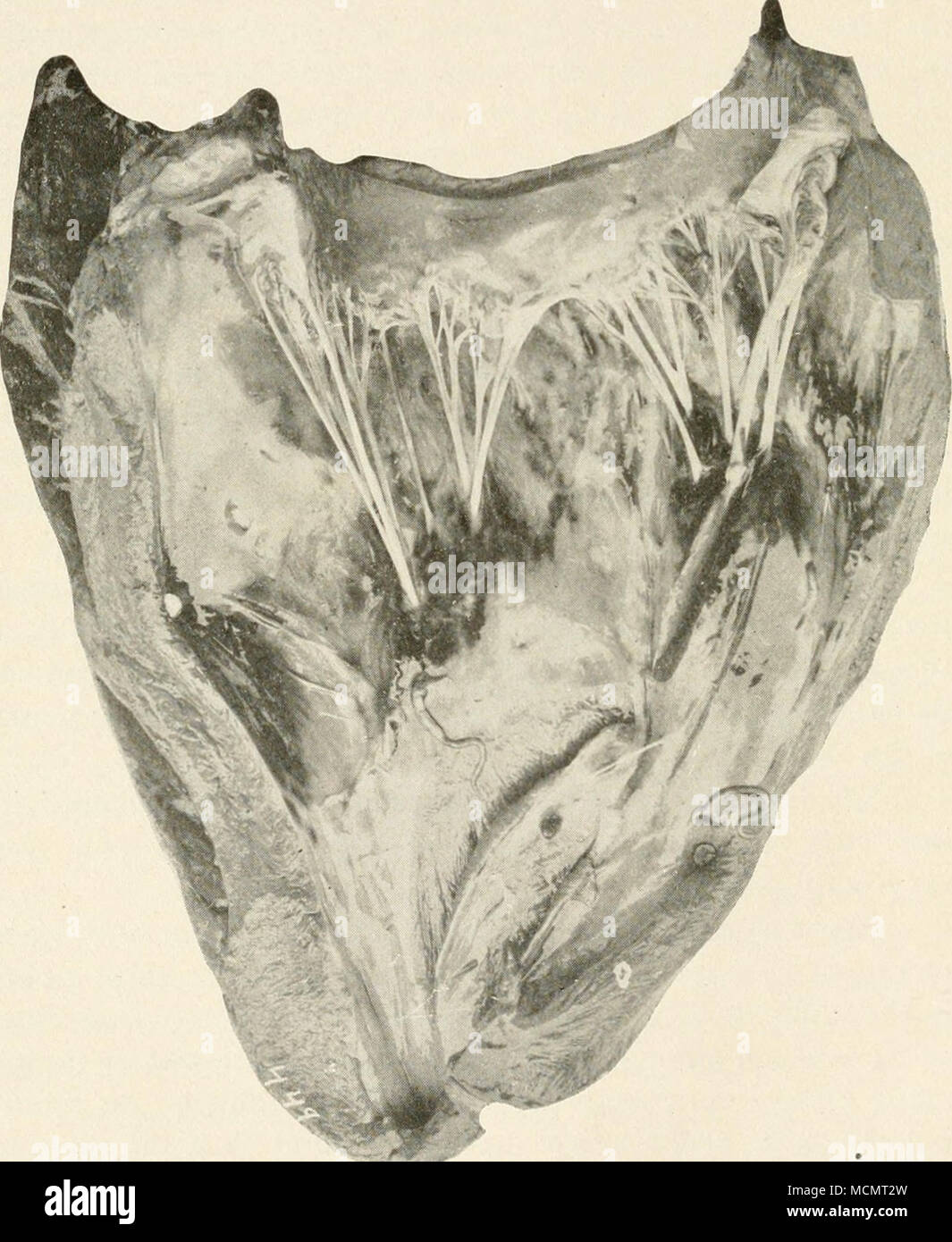 . Abb. 14. Foto sho iOing hcDiorrhages unter dem eiidocardiu-tn der rechten Herzkammer (Reynolds). Viel beteiligt. Eine genauere Untersuchung zeigt jedoch, in der Regel, daß, während einige der Minute Blutungen sind in der Stockfoto