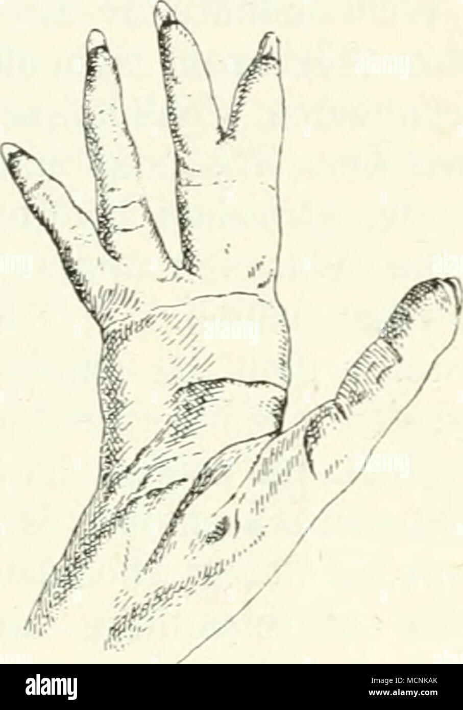 . Abb. 557. Plantarflächf des rechten Fußes von Hy-lobates syndactylus. Zur Andeutung der opponier-baren 1. Zehe und der Syn-dactylie der 2. u. 3.; / dollo. : -3. Familie: Anthropomorphae. Die Familie der Menschenaffen umfaßt Dri^ Ich. Durch die Summe ihrer Merkmale von Menschen in vielerlei Hinsicht am ähnlichsten Atfen der Alten Welt, sterben / Körpergröße Intellekt und alle übrigen Aifen über-ragen und sich unter Beispiele in verschiedenen Organen am meisten speziali-sierten und damit vom Ursi) i' ünglichen Zustand sich entfernten. Es sind im Ganzen i' Uhige. in ihien langsame Bewegungen, durch Stockfoto