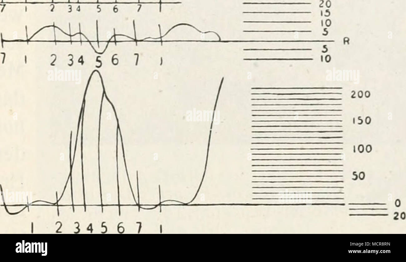 . Abb. 471. Schema des Blutstromes in der V. jugularis Ext / Burton-Opitz. Die oberste Kurve is also sterben GeschwindigkeitsverÃ¤nderungen in der Vene, die mittlere sterben Druckschwankungen im Vorhof und die untere Sterben in der Kammer ein. 1 â 2, Vorhofsystole; 2 - 3, Erschlaffung des Vorhofes; 2 - 6, Kontraktion der Kammer; 6 - 7, Erschlaffung der Kammer; 7 - 1, Pause. 1 Frangois-Franck, Gaz. liebd., 1882, S. 224; Arch.de phy^ io 2 Vgl. auch Gerhardt, Arch. f. cxp. Pathol., 34, S.415; 1894; Pathol., 6, S. 635 und 1909. 3 Frangois-Franck, Gaz. hcbd., 1882, S. 223; Arch.de * Vgl. Edens, Deutsches Arch. w. Stockfoto