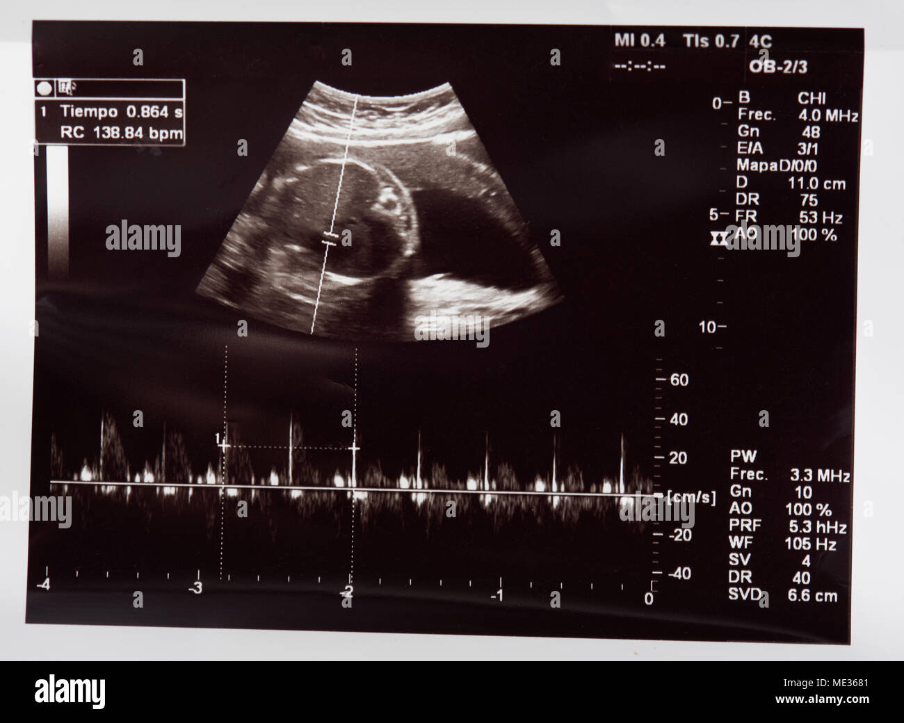 Herzschlag des Babys in schwangeren Bauch auf Ultraschall Stockfoto