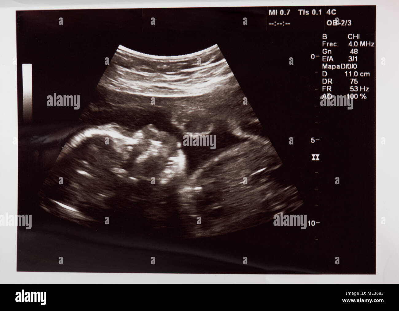 Baby Kopf auf Ultraschall im Krankenhaus überprüfen Scannen Stockfoto