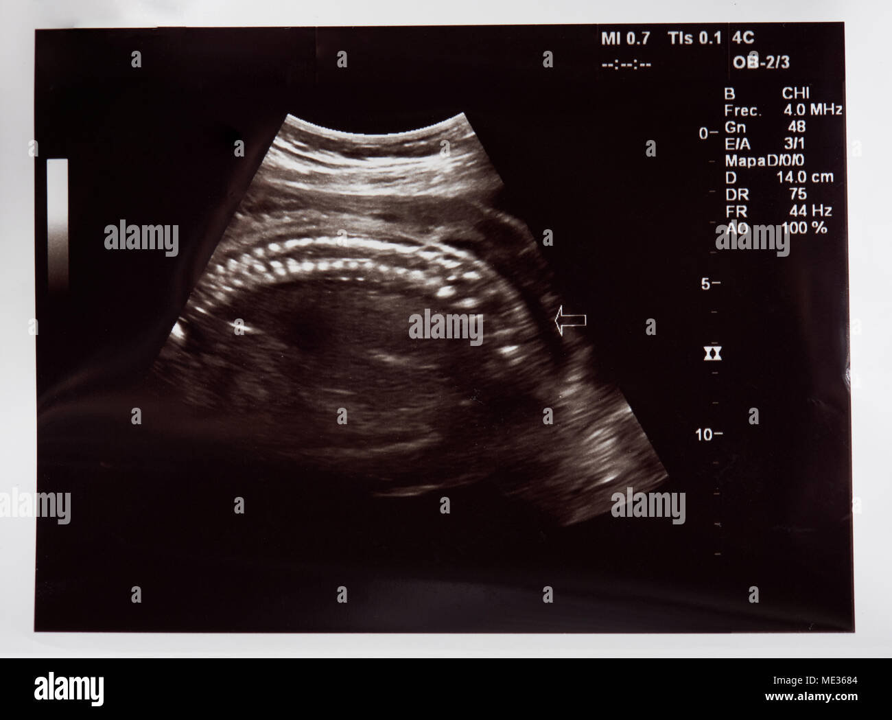 Ultraschall der schwangeren Frau, Kind Wirbelsäule Stockfoto