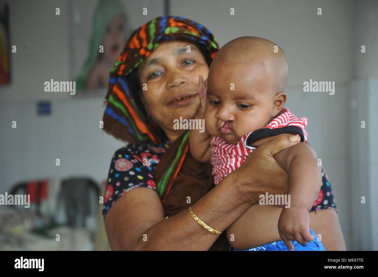 Geburtsfehler baby boy mit Hasenscharte in Dhaka Medical College brennen Einheit in Bangladesch. Stockfoto