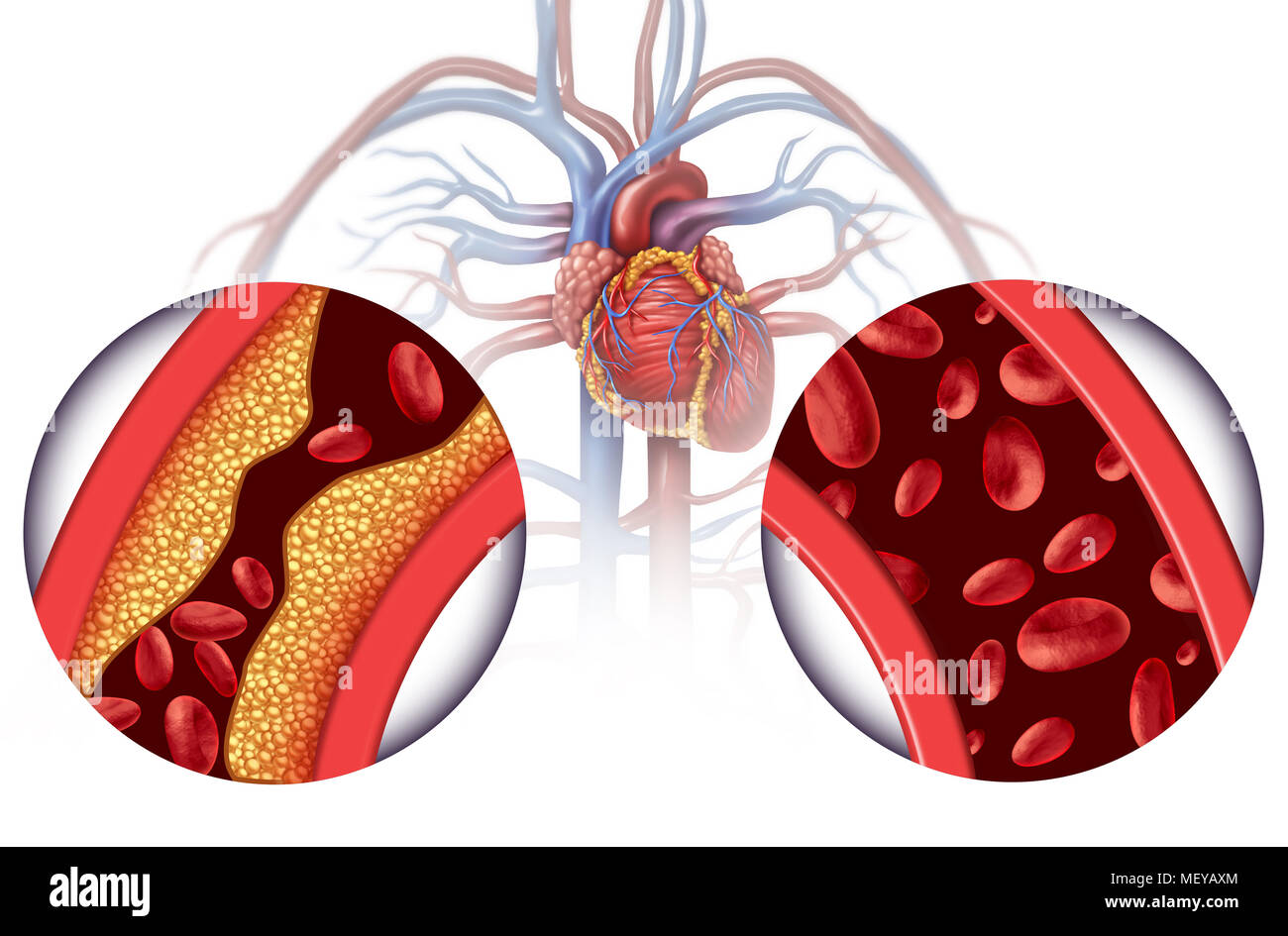 Chelattherapie und Herzkrankheit Behandlung Konzept als Alternative Medizin für den menschlichen Blutkreislauf Krankheit mit 3D-Illustration Elemente. Stockfoto