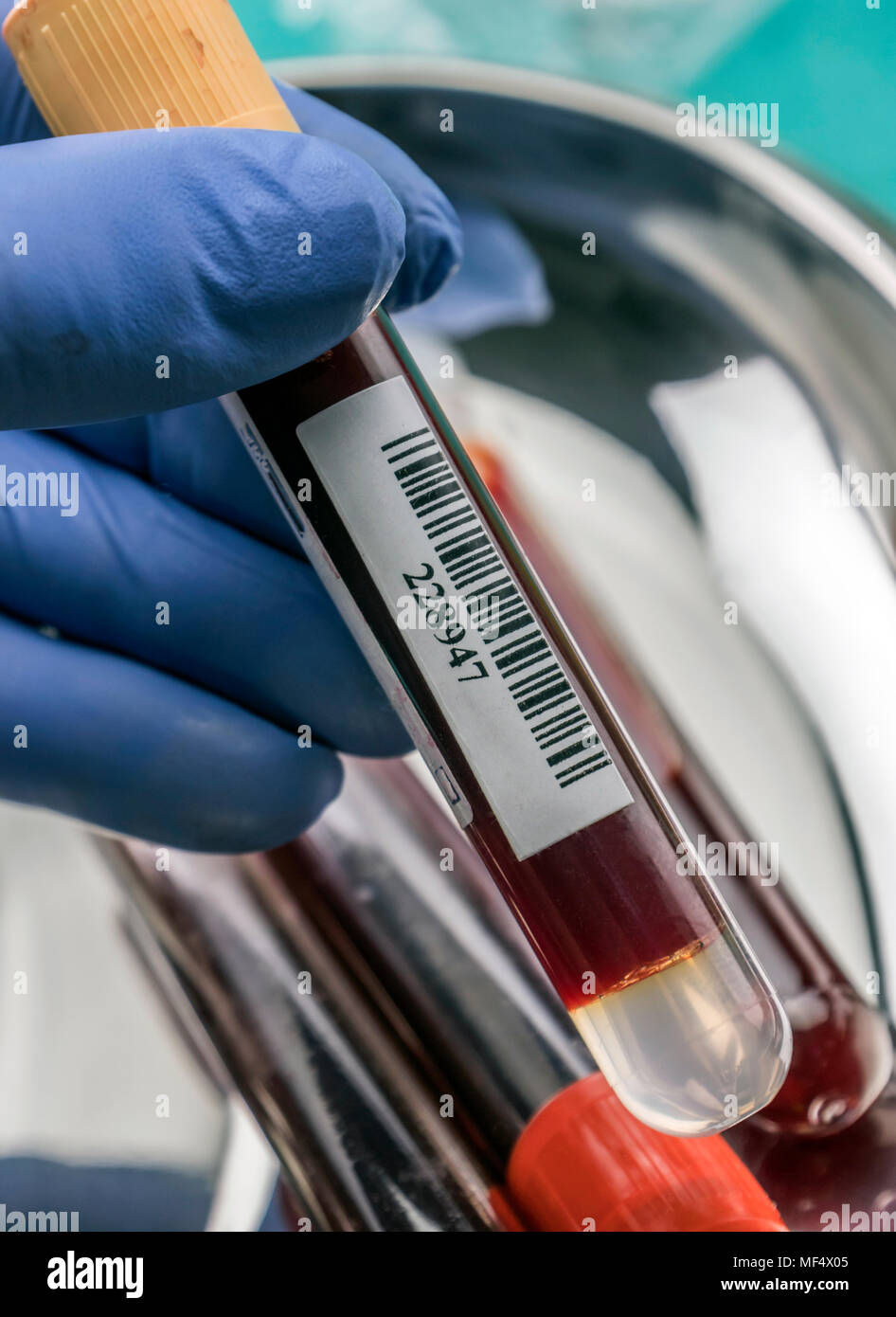Arzt hält Blutprobe an einem Krankenhaus Tabelle, konzeptionelle Bild Stockfoto