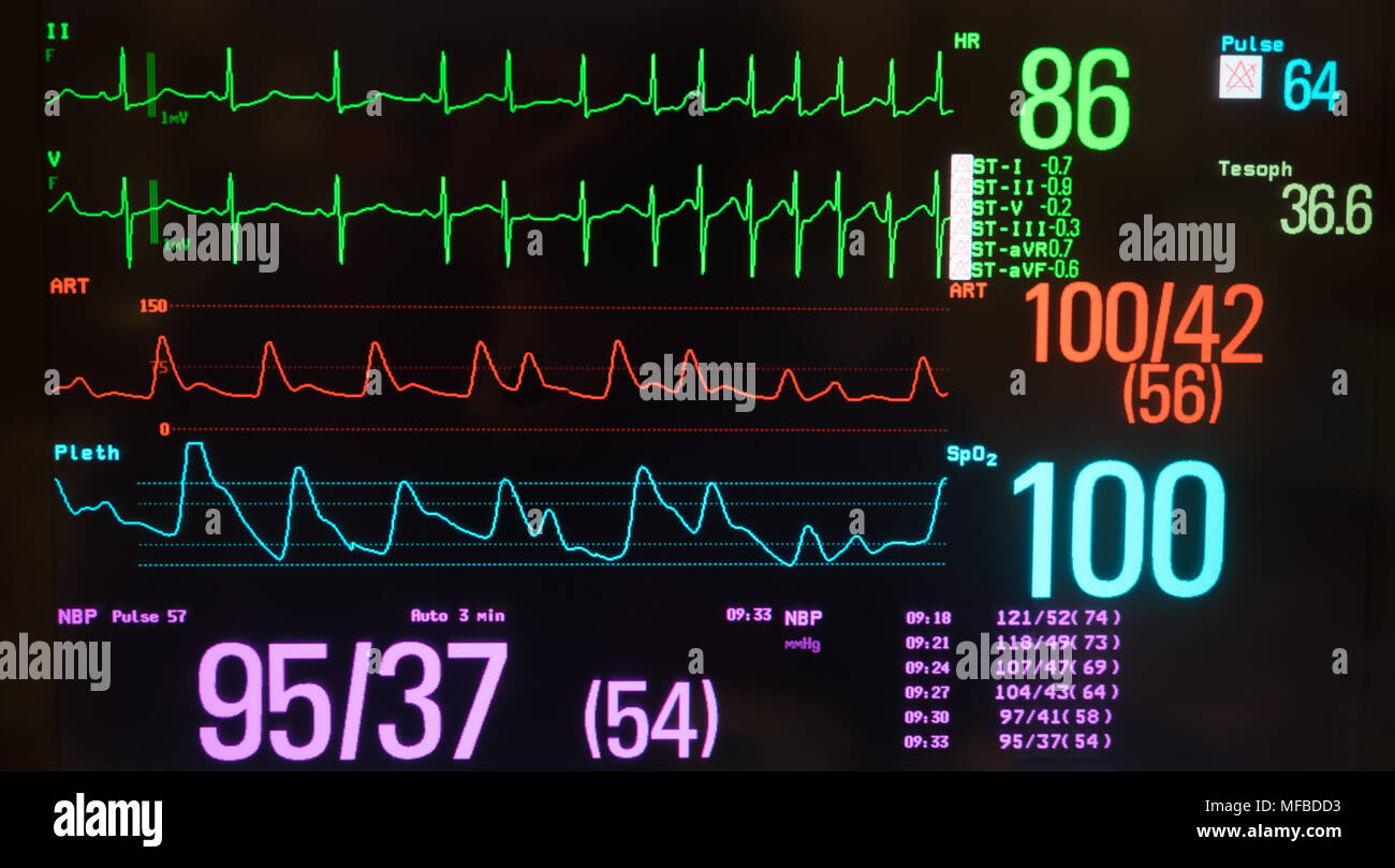 Eine schwarze geschirmt Monitor zeigt normale Sinusrhythmus durch supraventrikuläre Tachykardie in Grün gefolgt, den Blutdruck in Rot, Sauerstoffgehalt in Blau. Stockfoto