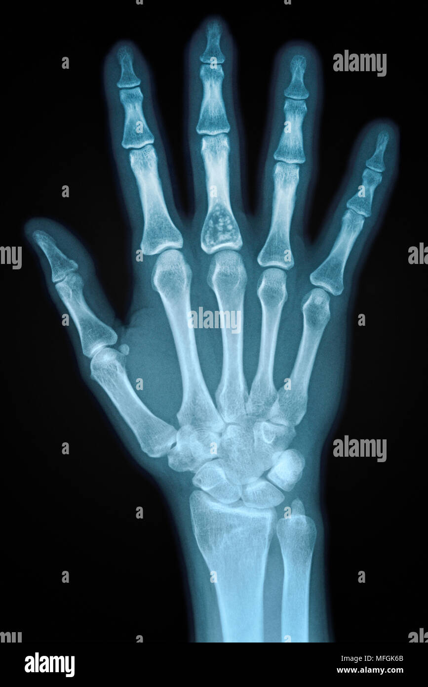 Hand X-ray von einem erwachsenen weiblichen Stockfoto