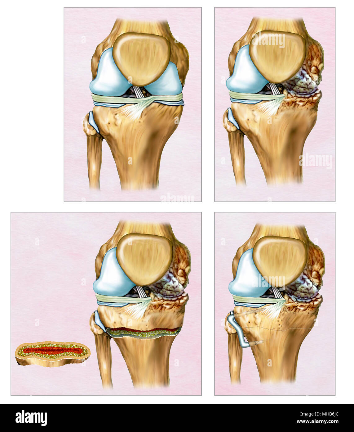 Beschreibende Darstellung eine Osteotomie oder Korrektur der Knie Stockfoto
