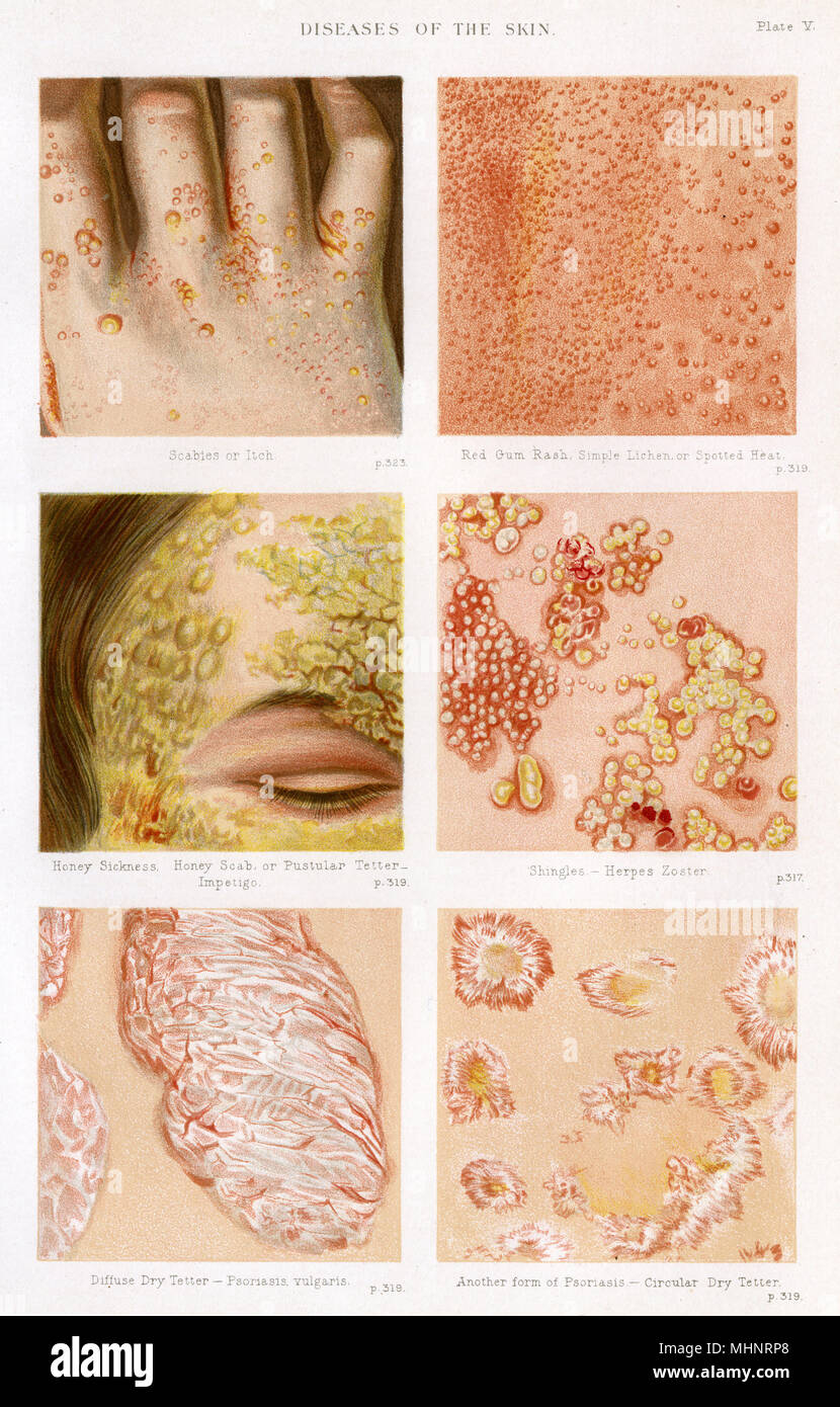 Erkrankungen der Haut - Platte 5 Stockfoto