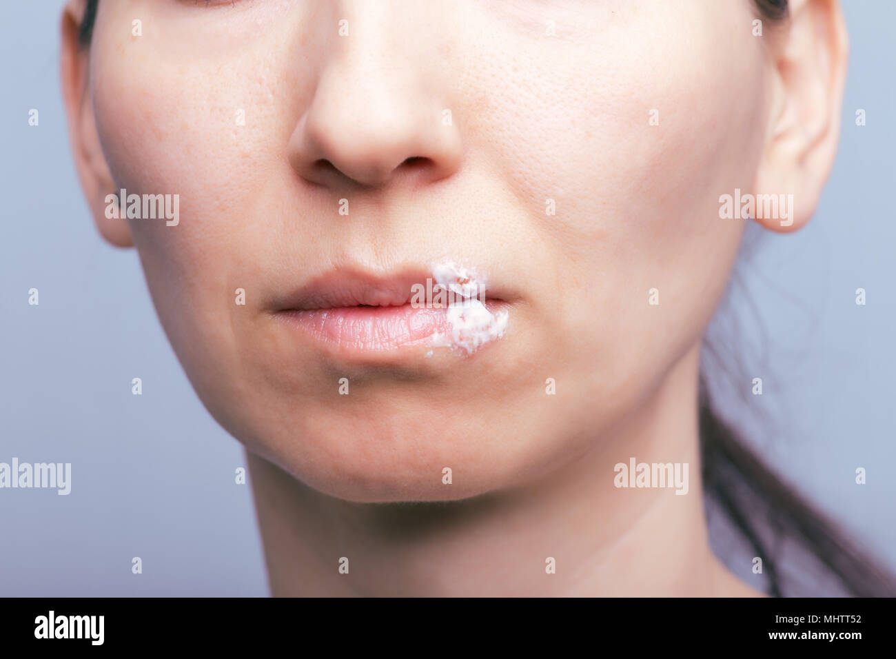 Makroaufnahme von Herpes Virus auf Mund der jungen Frau. Herpes verschmiert mit heilender Salbe Stockfoto