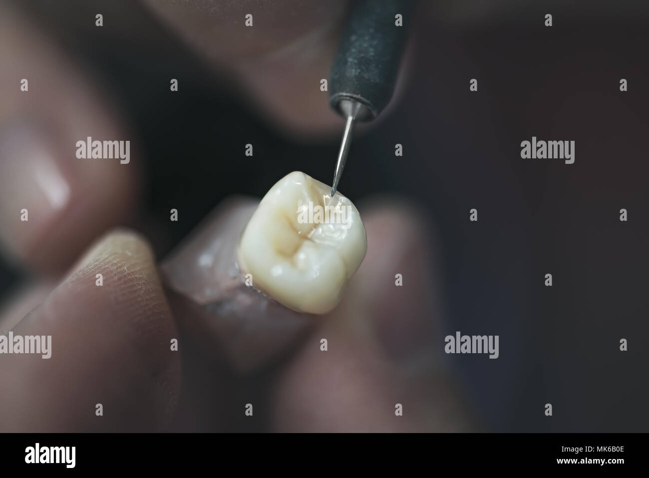 Künstlicher Zahn durch eine Prothese Specialist getan. Stockfoto