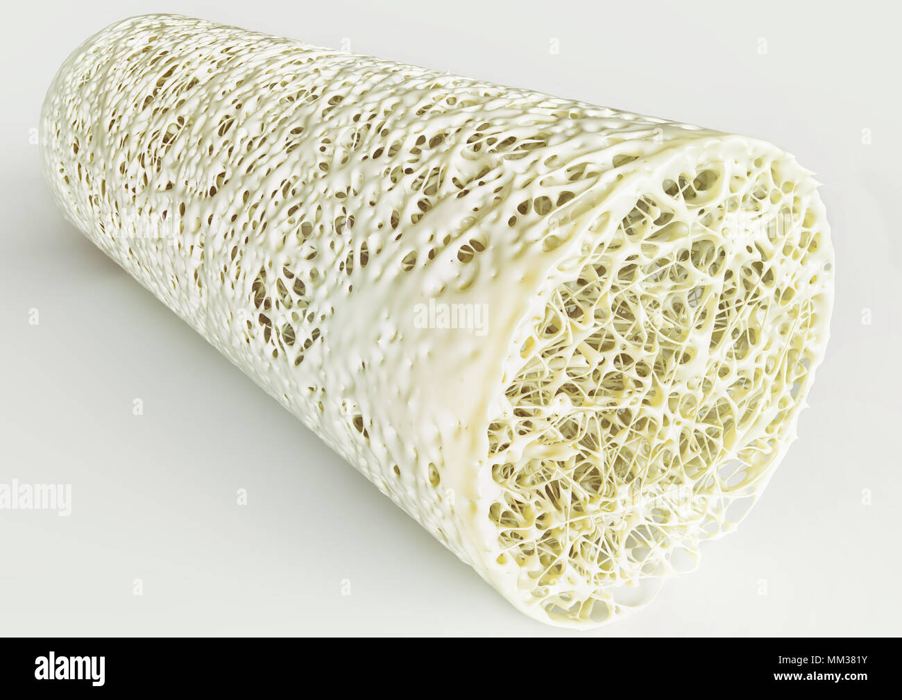 Querschnitt einer fortgeschrittenen Osteoporose - hohe Details - Stufe 4 - 3D-Rendering Stockfoto