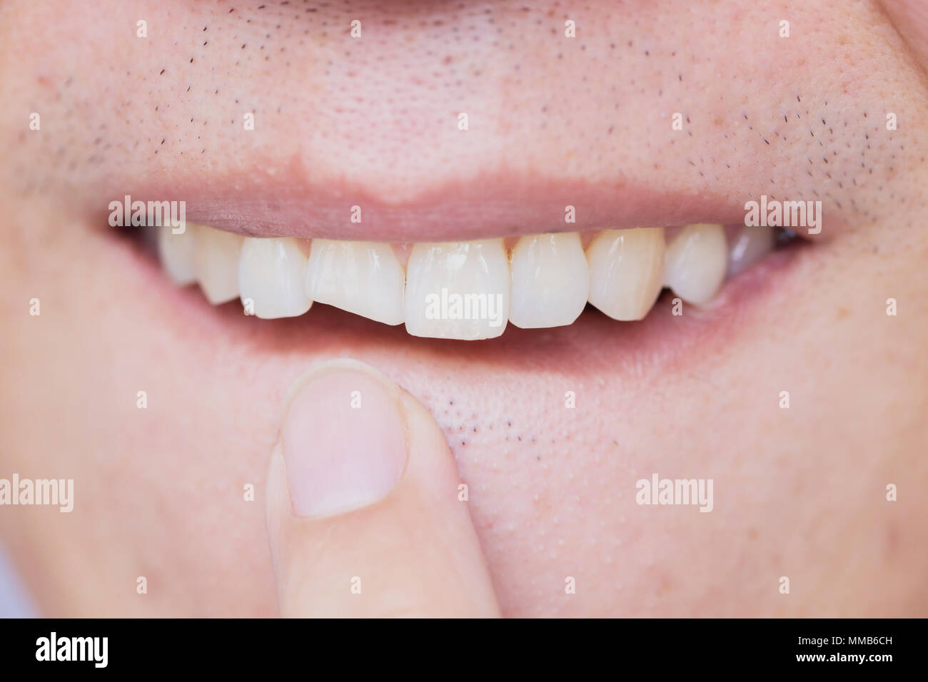 Männliche gebrochene Zähne beschädigt gerissenen vorderen Zahn Zahnarzt benötigen, zu beheben und zu reparieren. Stockfoto