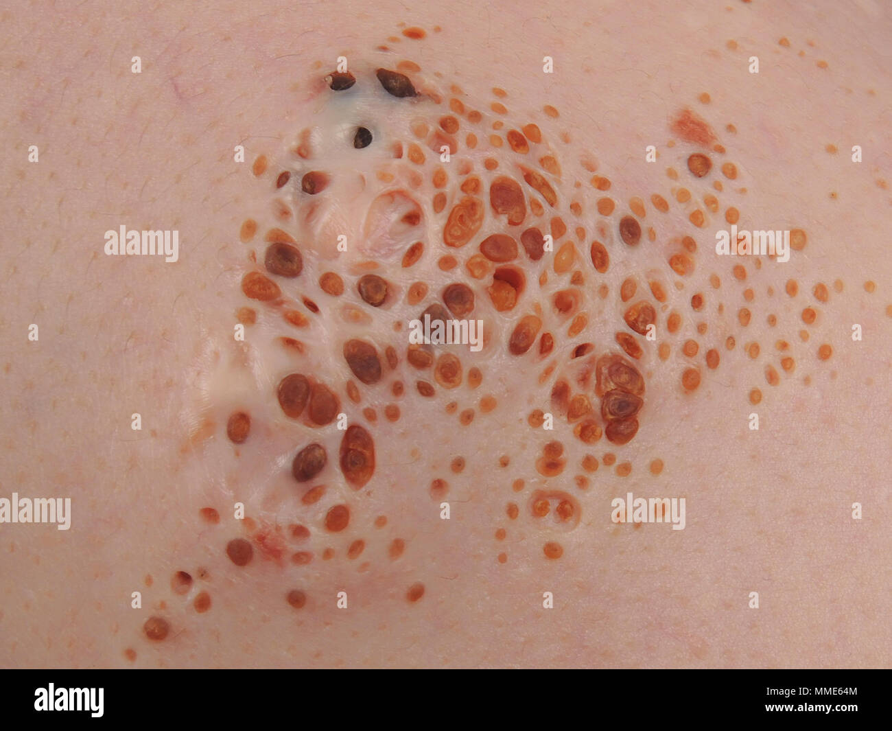 Hamartom Fotos und Bildmaterial in hoher Auflösung Alamy