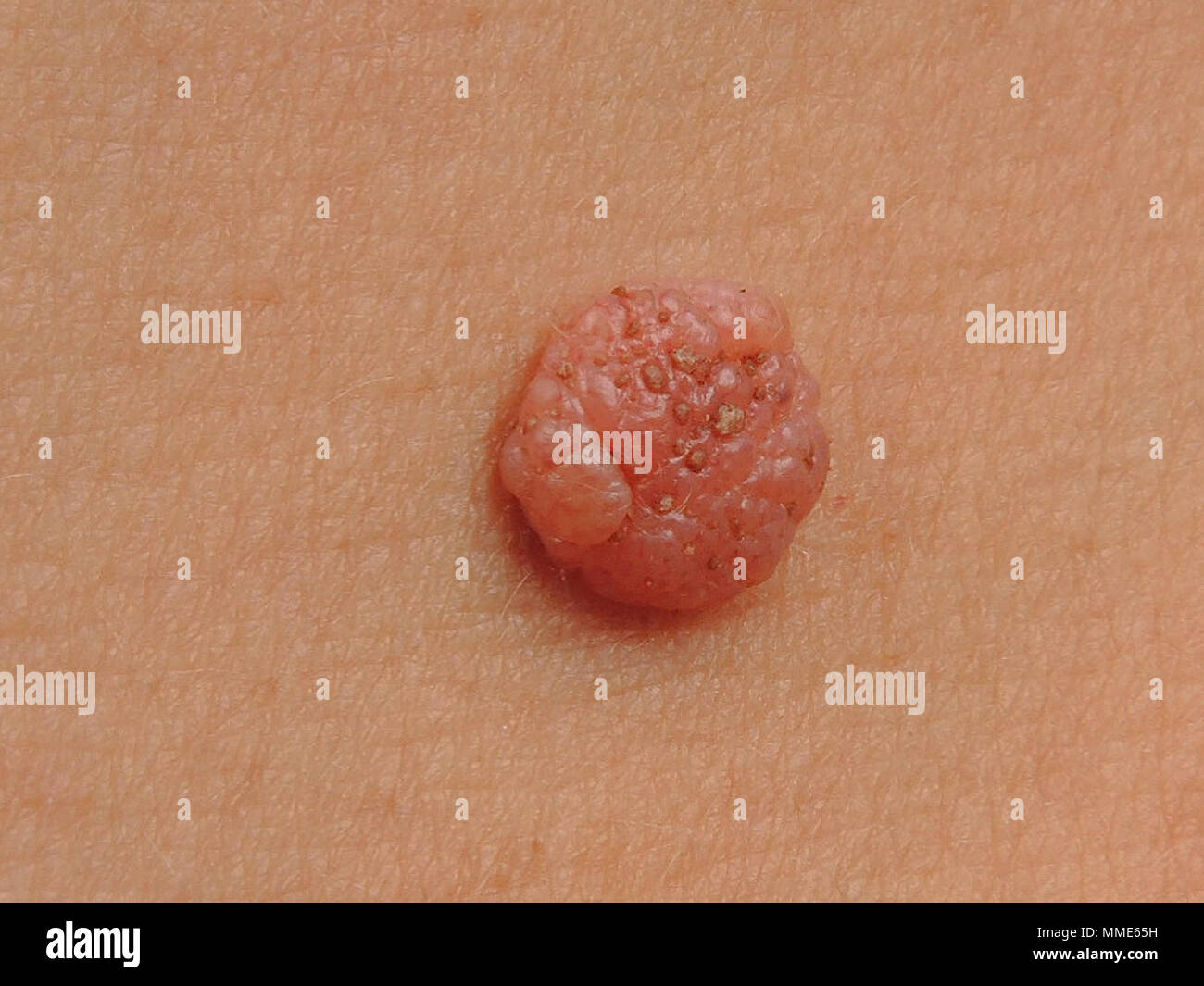 Intradermal nevus Fotos und Bildmaterial in hoher Auflösung Alamy