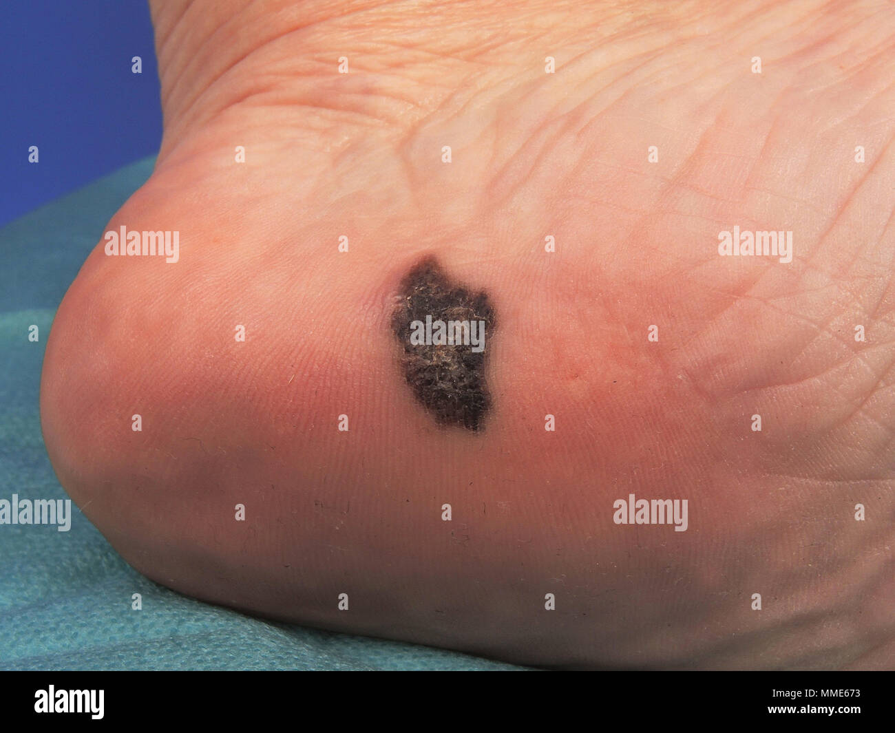 MELANOM Stockfoto