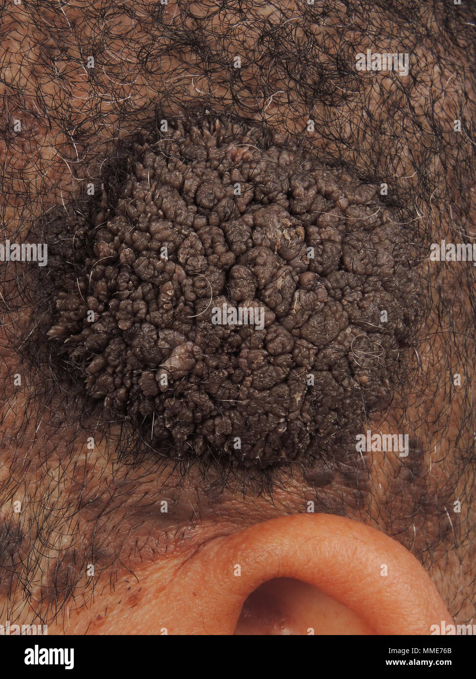 SEBORRHOISCHE KERATOSE Stockfoto