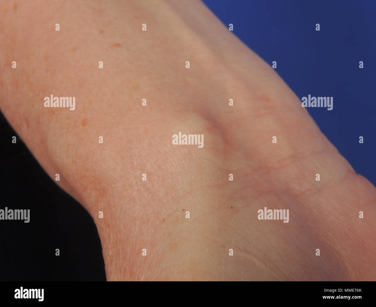 Zyste ganglion Fotos und Bildmaterial in hoher Auflösung Alamy