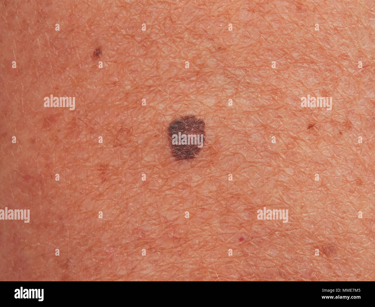 MELANOM Stockfoto