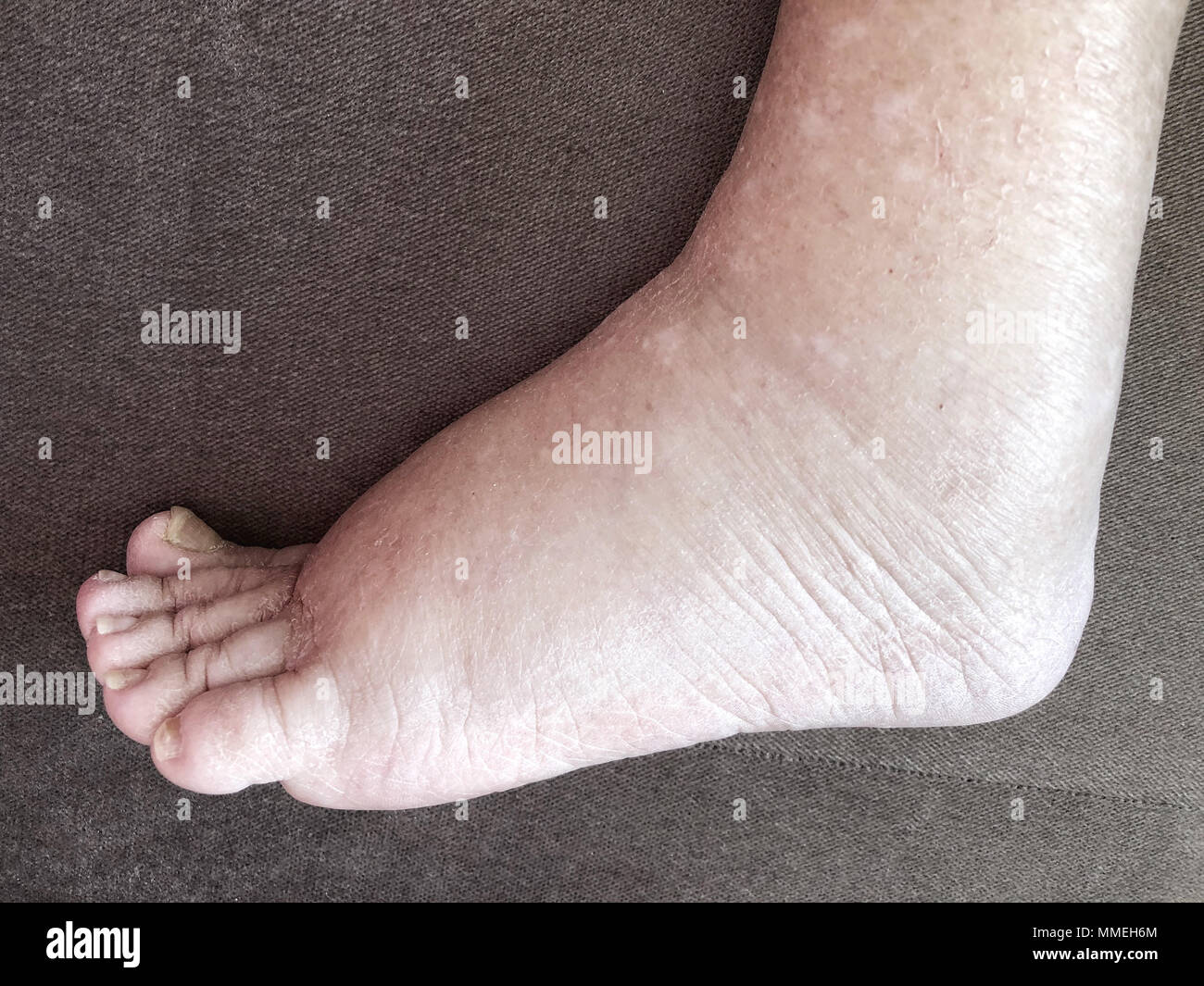 Closeup Fuß des erkrankten Patientin, die von Ödem Krankheit leidet Stockfoto