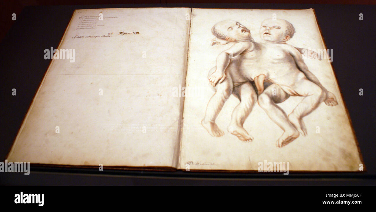 . Englisch: Dissection Bericht über siamesische Zwillinge von Albrecht von Haller. . 1735. Zeichnung von Johann Sebastian Dür, 1735. Haller Sektionsbericht Stockfoto