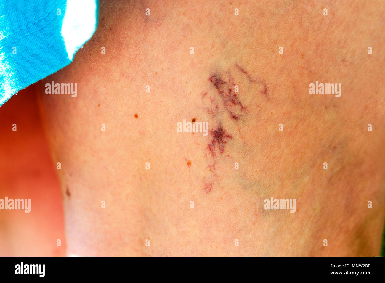 Dermis von Krampfadern an den Beinen betroffen. Close-up. Stockfoto