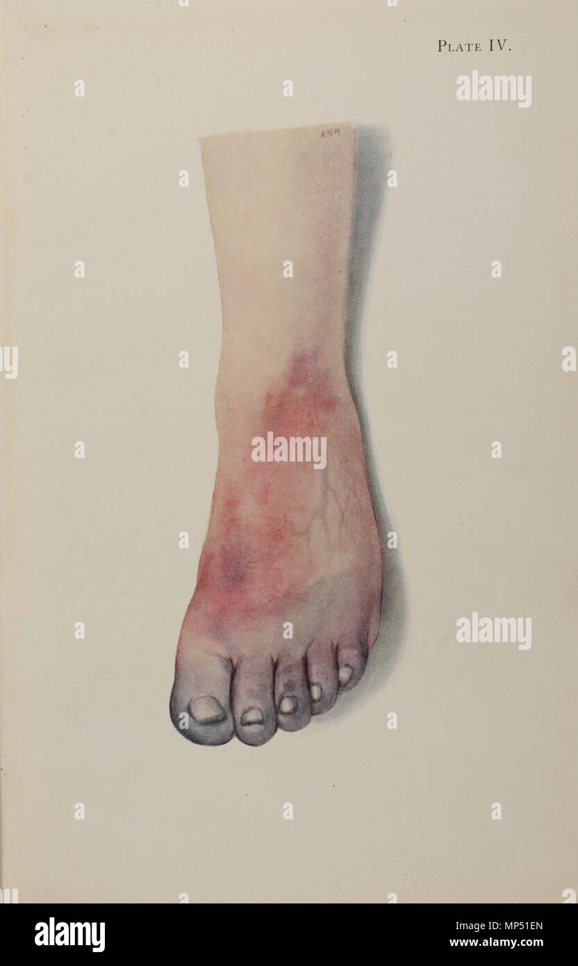 Platte IV. Englisch: Platte IV von einem Atlas der Gasvergiftung durch das amerikanische rote Kreuz und die medizinische Forschung (American Red Cross, 1918). Platte Titel: 'Gangrän der Fuß durch vaskuläre Thrombosen von Chlor Vergiftung verursacht.' Text beginnt: "Geschichte der Fall. Vergast durch Chlor im Jahr 1915 unter Bedingungen, die nicht frostsicher - Biss verursacht haben könnte. Schwere dyspnoe von Lungenödem. ... "Das Amerikanische Rote Kreuz veröffentlicht dieser Leitfaden für die American Expeditionary Force im Ersten Weltkrieg, manchmal Krieg die "Chemiker" genannt." Die chromolithograph Platten von charakteristischen Verletzungen waren auf beabsichtigte Stockfoto