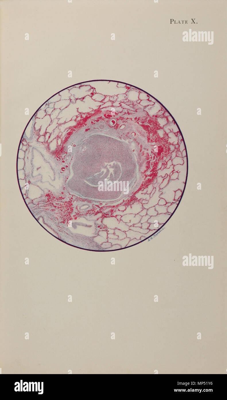 Platte X. Englisch: Platte X von einem Atlas der Gasvergiftung durch das amerikanische rote Kreuz und die medizinische Forschung (American Red Cross, 1918). Platte "icroscopic Abschnitt der menschlichen Lunge von senfgas Vergiftung, mit dem Tod am Ende des zweiten Tages (40 Stunden)." Text beginnt: "Die bronchiole ist mit Fibrin und Eiter Zellen gefüllt, und sein Futter Epithel wurde komplett zerstört worden. Die Entzündung hat einen charakteristischen Ring der Blutung in das Gewebe um die bronchialen Schlauch verursacht und die Infektion beginnt in den Alveolen in Ihrer Nähe zu diesen entzündete Gewebe erscheinen. Aber es ist kein ge Stockfoto